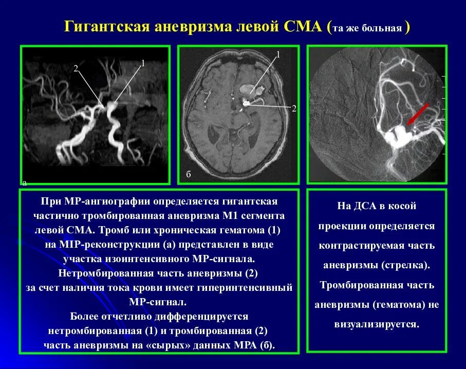 Мрт сердца и коронарных сосудов с контрастированием. Стеноз огибающей артерии. Мрт после стентирования. Состояние после стентирования оса и вса. Стеноз общей сонной артерии.