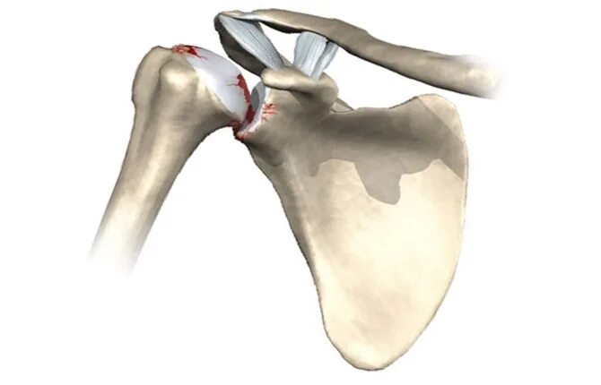 остеохондроз плечевого сустава. мышцы. боль в суставах. синовит плечелопаточного сустава. остеохондроз плечевого сустава симптомы и лечение.