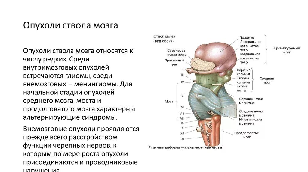 Диффузная опухоль ствола головного мозга. Глиальная опухоль головного мозга. Опухоль продолговатого мозга. Фибриллярная астроцитома макропрепарат. Опухоль среднего мозга.