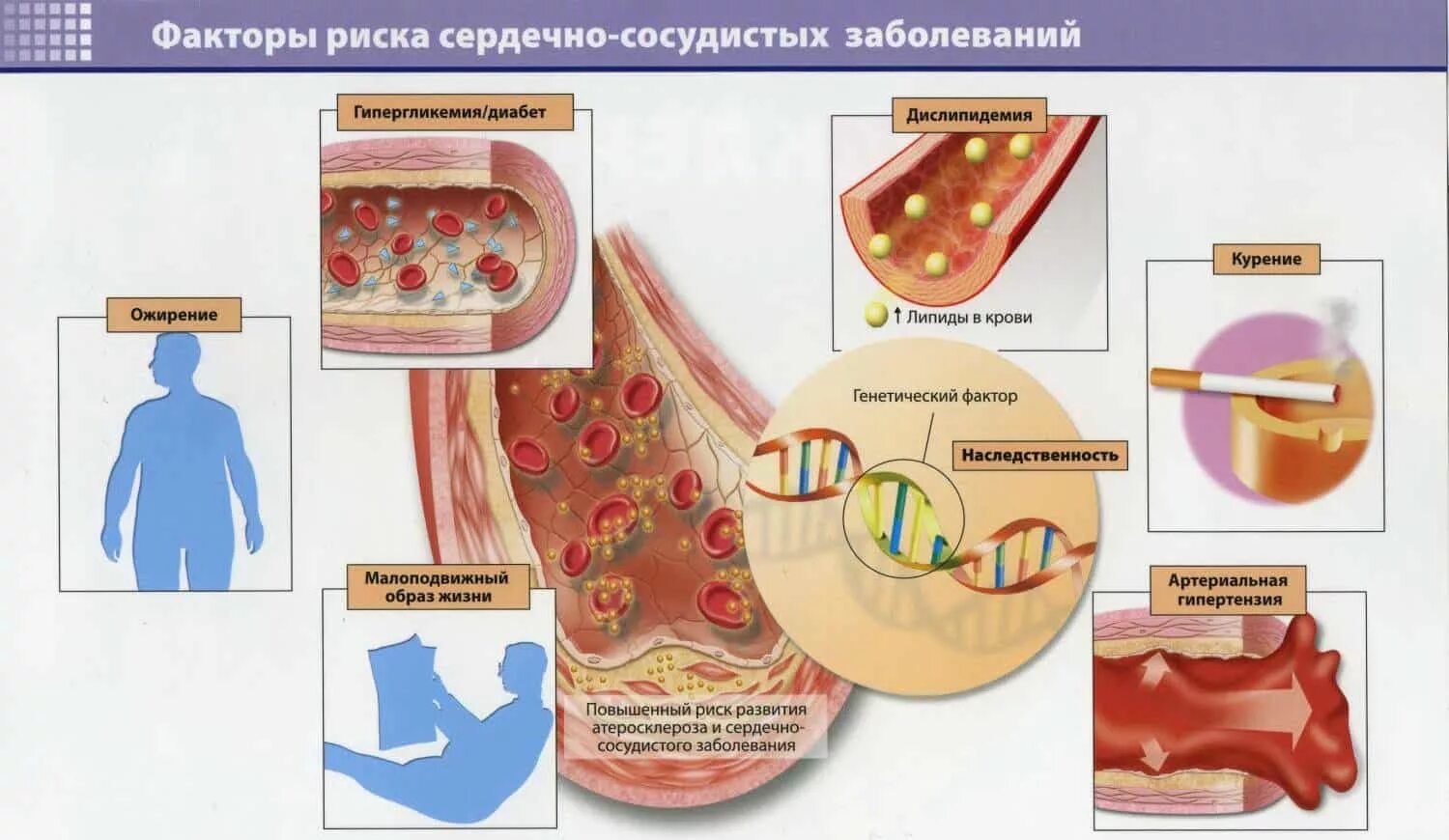 Высокий холестерин риск. Дислипидемия фактор риска атеросклероза. Атеросклероз коронарных артерий факторы риска. Факторы риска развития атеросклероза сосудов:. Факторы риска атеросклероза и и ишемической болезни.