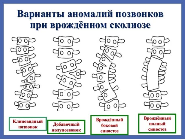 Аномалии развития позвонков поясничного отдела. Клиновидная деформация th7 позвонка. Клиновидная деформация деформация позвонка. Врожденная аномалия развития грудного отдела позвоночника.