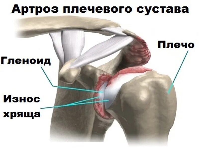 Гленоид плечевого сустава. Суставная фиброзно-хрящевая губа гленоида. Фиброзно хрящевая губа гленоида лопатки. Фиброзно-хрящевая губа гленоида плечевого сустава. Разрыв губы гленоида