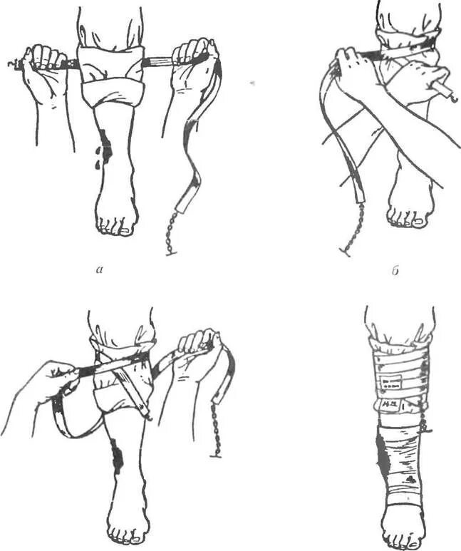 Наложение жгута для остановки кровотечения. Наложение кровоостанавливающего жгута схема. Остановка кровотечения накладывание жгута;. Наложение жгута Эсмарха. Как остановить кровотечение конечностей