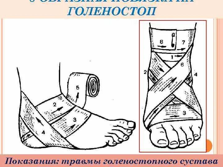 Повреждение голеностопного сустава какая повязка. Наложение повязки на голеностопный сустав алгоритм. колосовидная повязка на голеностопный сустав алгоритм. крестообразная повязка на голеностоп. восьмиобразная повязка на голеностопный сустав.
