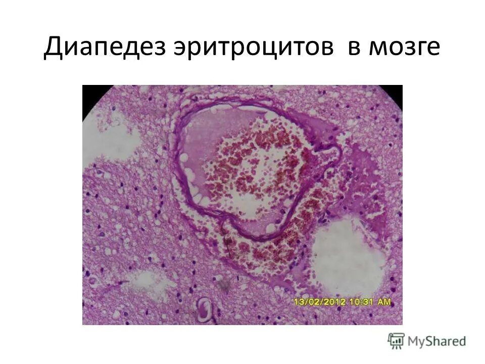 Диапедез эритроцитов это. Диапедез эритроцитов это. Диапедез форменных элементов крови. Диапедез лейкоцитов. Диапедез эритроцитов это.