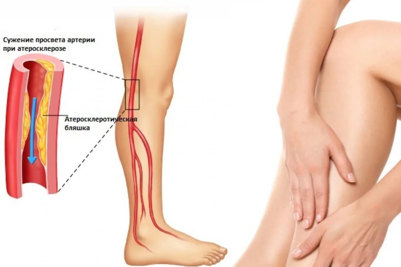 Атеросклеротическое поражение нижних конечностей