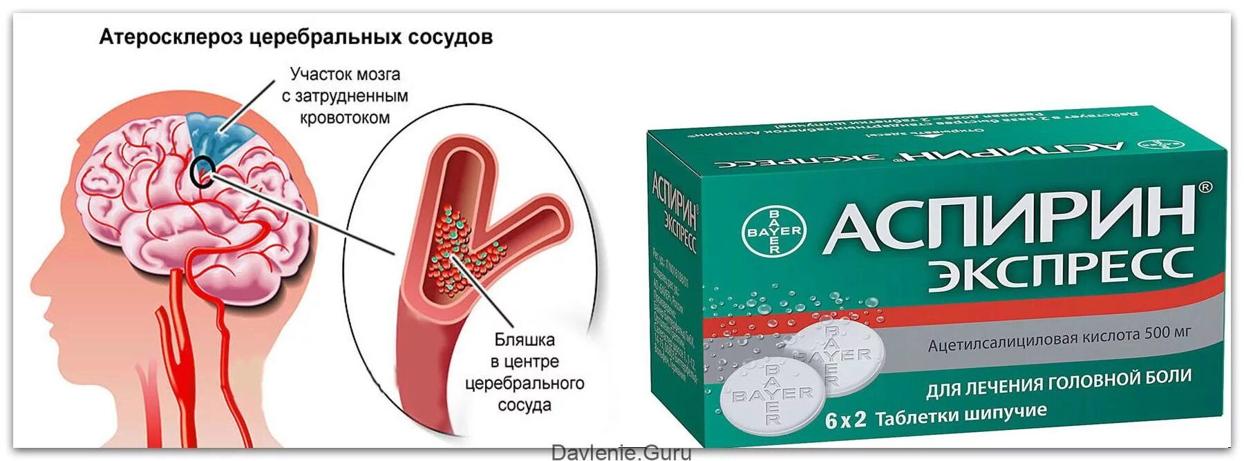 Медикаментозное лечение сосудов. Лекарство от атеросклероза сосудов. Лекарство от атеросклероза сосудов головного. Таблетки от церебрального атеросклероза. Средство от атеросклероза сосудов головного мозга.