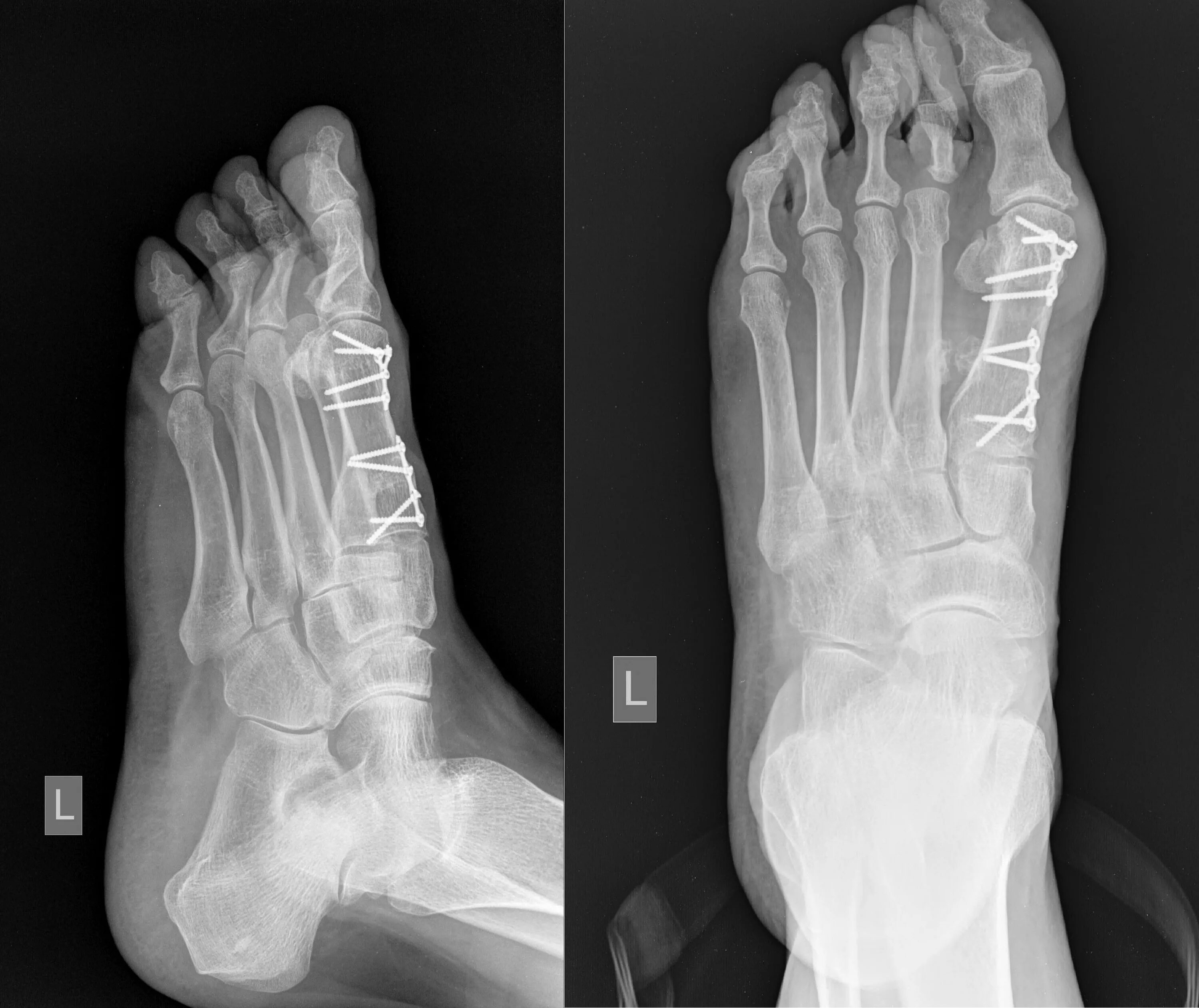 пяточно вальгусная косолапость. деформация стопы видео. гимнастика при вальгусной деформации стопы после операции. выпирающие косточки на ногах feet. деформация стопы видео.