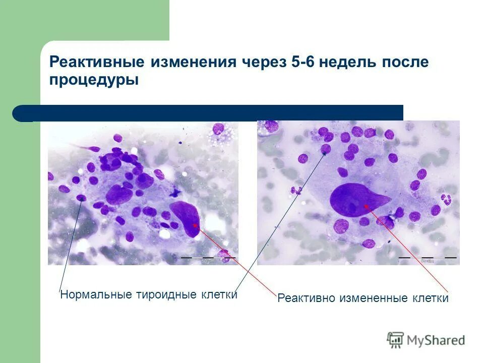 Часть клеток с реактивными изменениями