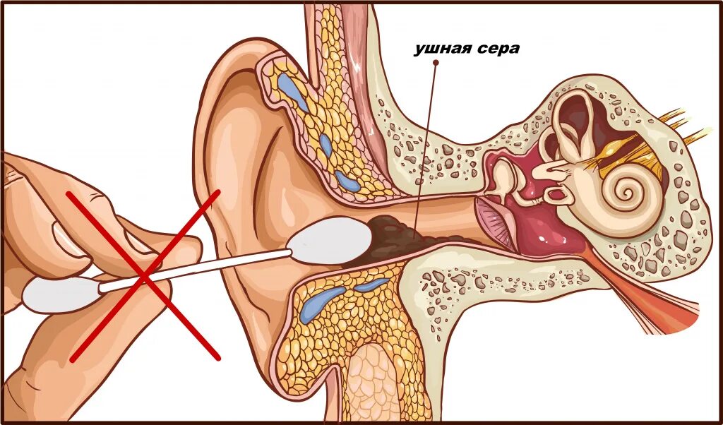 Заложило ухо ватной палочкой что делать. Барабанная перепонка отит. Наружный отит серная пробка. Серная пробка ушная палочка. Отит барабанная перепонка лопнула.