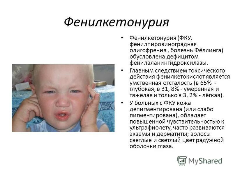 Фенилкетонурия моногенное заболевание егэ. Фенилкетонурия симптомы у грудничка. фенилкетонурия (фенилпировиноградная олигофрения). болезнь фенилкетонурия. болезни детей с умственной отсталостью.