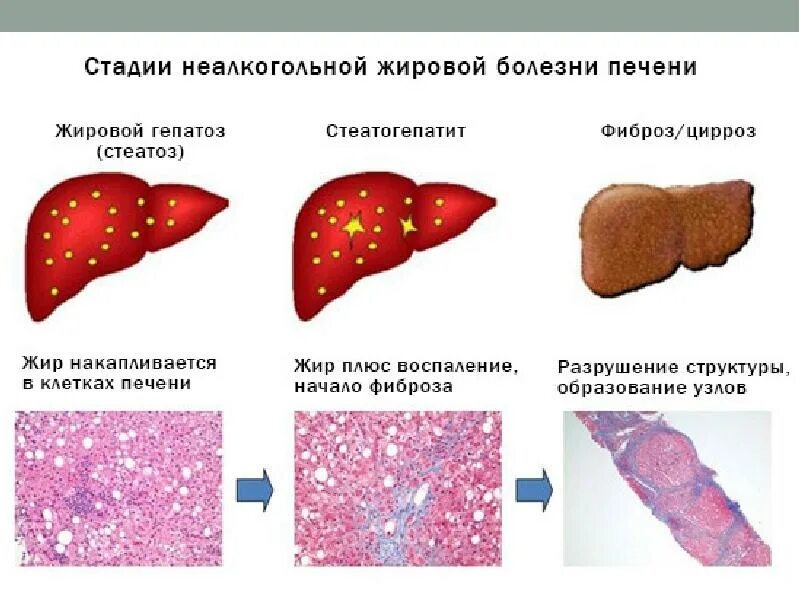 Что такое стеатоз поджелудочной железы. Неалкогольная жировая болезнь печени степени. Жировой гепатоз печени 2 степени. Стадии развития болезни печени.