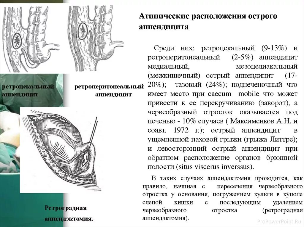 Температура после аппендицита сколько