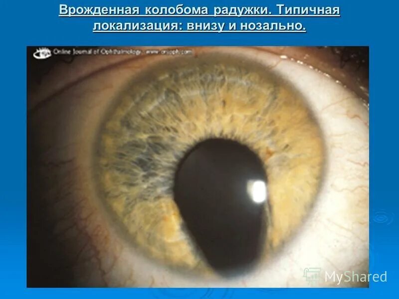 зрачок внизу