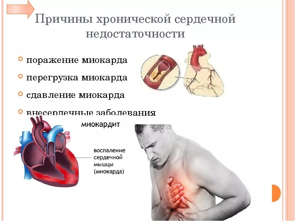 Сердечная недостаточность причины лечение. Сердечная недостаточность. Сердечная недостаточн. Сердечна янедостатояность. Хроническая сердечно-сосудистая недостаточность.