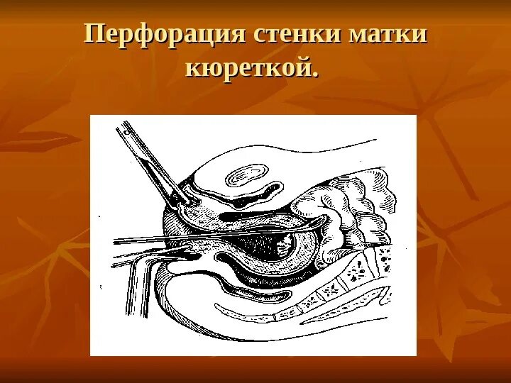 Как сделать матку