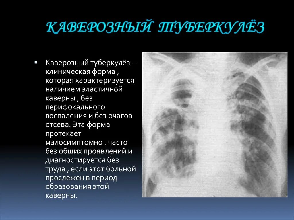 Закрытая форма туберкулеза можно ли заразиться