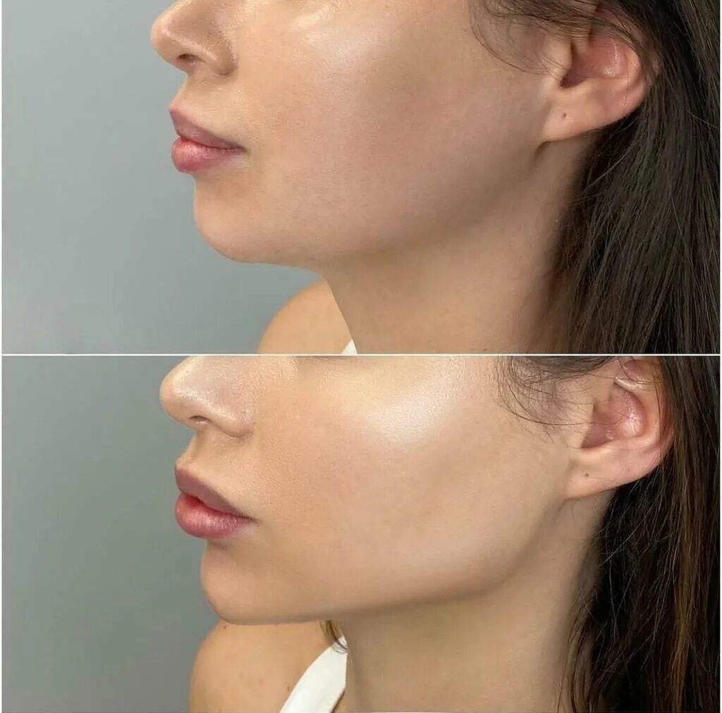 косметологические процедуры. профиль джоли углый нижний челюсти подбородка. красивая шея девушки. красивая шея. профиль косметология.