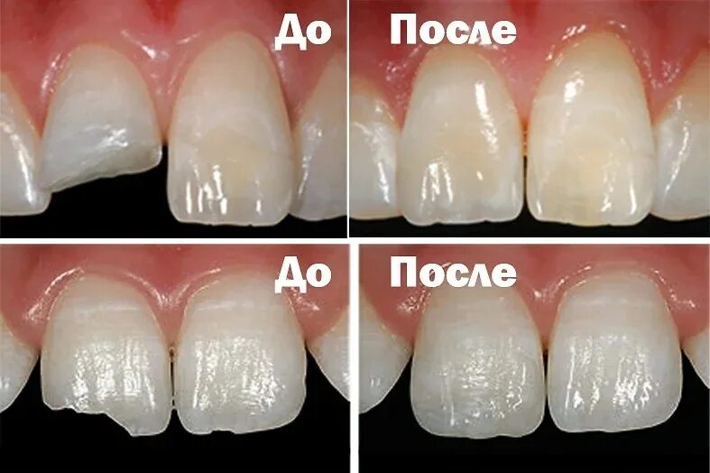 Винир реставрация. Светополимерная пломба. Световая фотополимерная пломба. Restovratsia zubov.