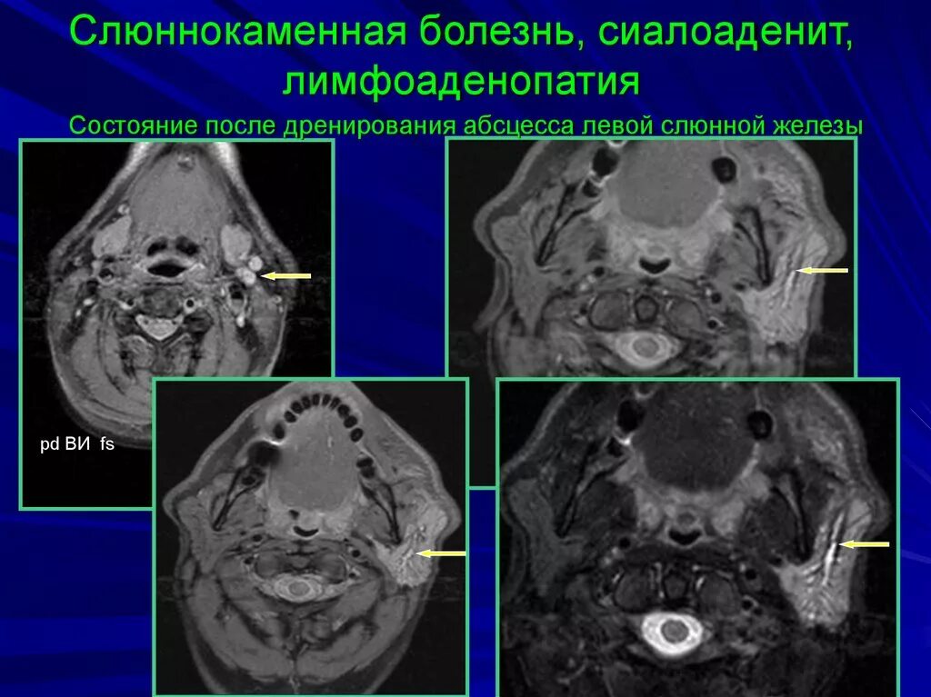 Опухоли слюнных желез