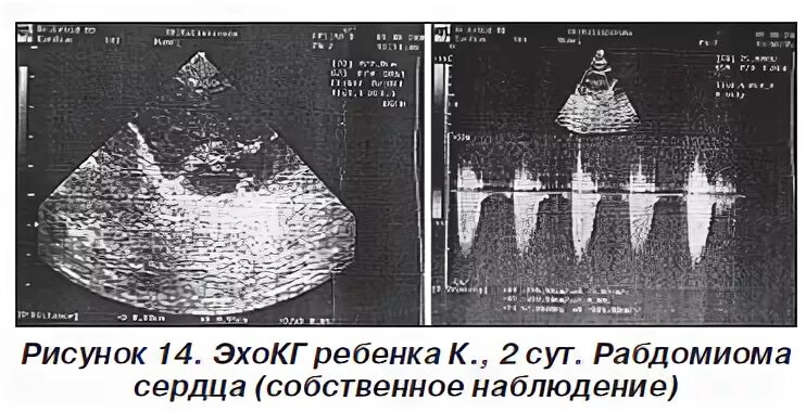 Рабдомиома сердца. Рабдомиома сердца у детей. Рабдомиома сердца эхокардиография.