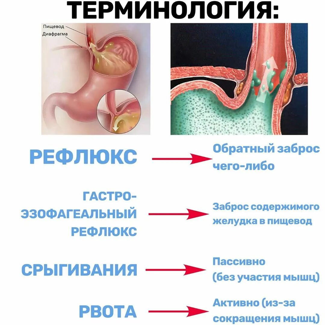 Как убрать рефлюкс. Гастроэзофагеальный (желудочно-пищеводный) рефлюкс. Рефлюкс эзофагит слюноотделение. Рефлюкс эзофагит на гастроскопии. Маточно трубный рефлюкс.