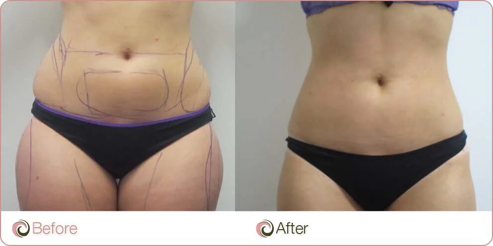 липосакция живота и боков отзывы. лазерная липосакция живота до и после. липосакция живота и боков. тумесцентная липосакция. тумесцентная липосакция.