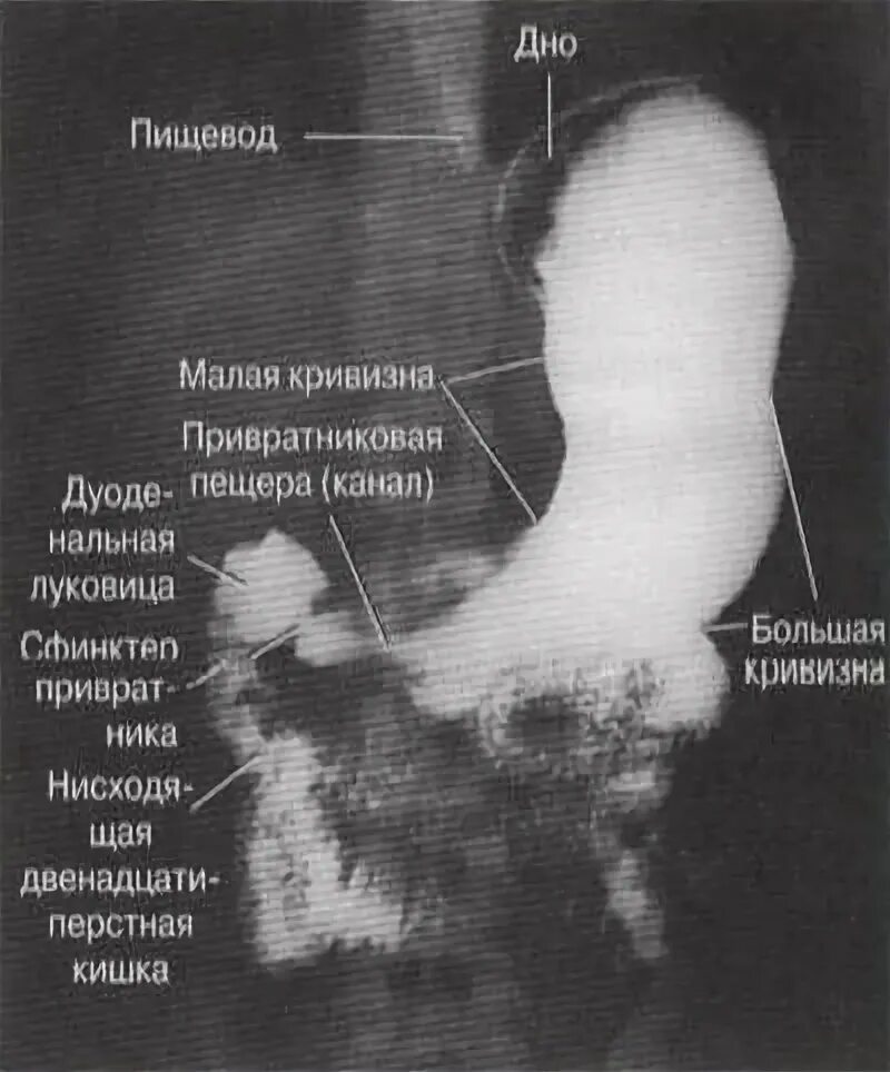 Рентгеноанатомия желудка. Рентгенография пищевода желудка и ДПК. Рентгеноскопия пищевода и желудка ДПК. Стеноз двенадцатиперстной кишки рентген. Скопия пищевода желудка