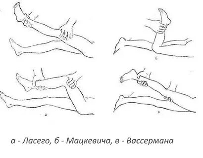 Симптом вассермана