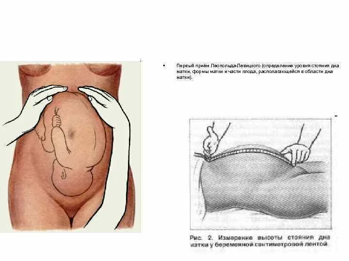 Приемы леопольда алгоритм. Наружные акушерские приемы Леопольда Левицкого. Приёмы Леопольда Левицкого в акушерстве. Акушерское исследование Леопольда Левицкого. Приёмы Леопольда Левицкого в акушерстве 4 прием.