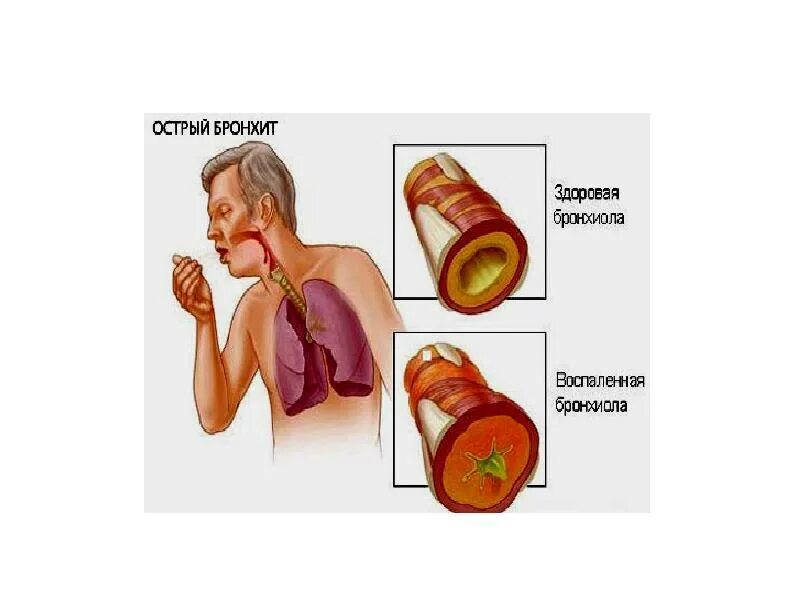 Бронхит бронхи. Острый и хронический бронхит. При остром бронхите поражаются бронхи. Острый бронхит классификация.