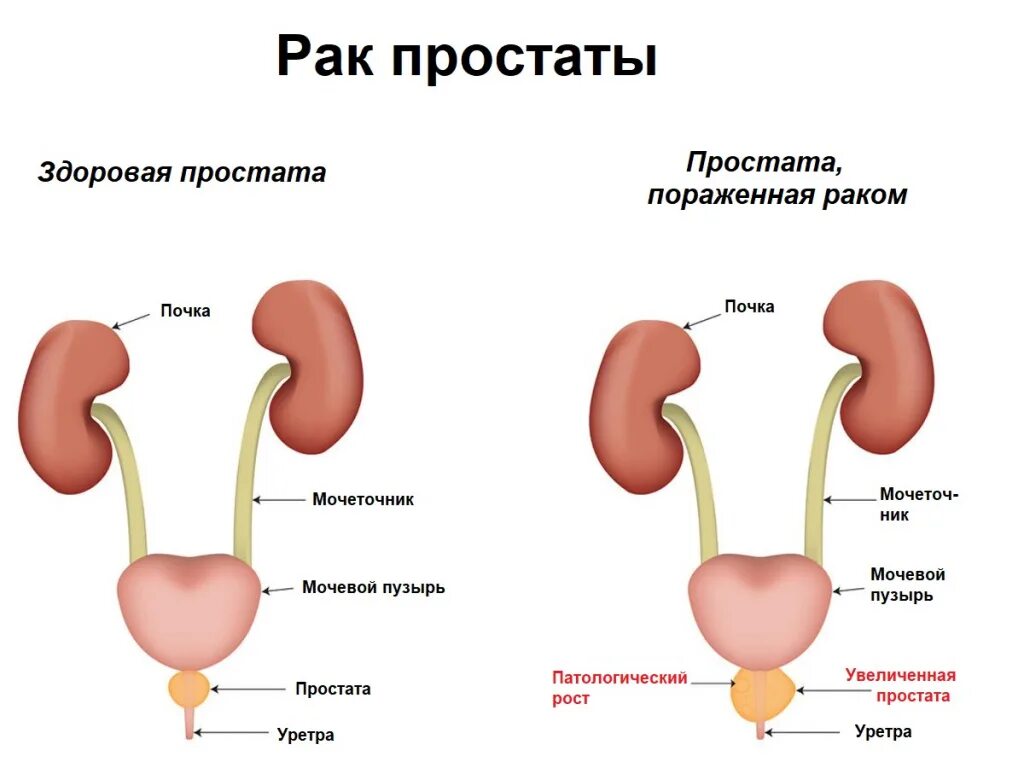 Рези в мочеиспускательном канале. Аденома мочевого пузыря. Мочевой пузырь и простата. Простудил мочевой пузырь. Мочевой пузырь простатата.