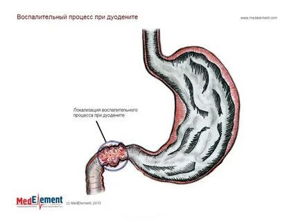 Дуоденит желудка лечение у взрослых препараты