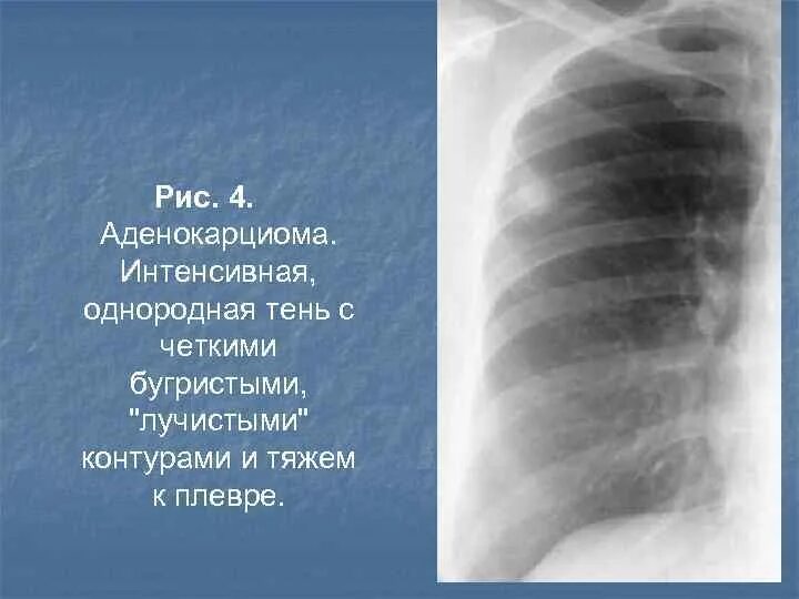 Округлыми формами в легком. Периферическое образование легкого с6. Периферическое новообразование легкого. Опухоль нижней доли левого легкого. Периферическая опухоль легкого.