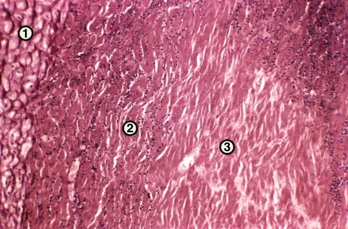 Участок ишемии. Острый инфаркт миокарда микропрепарат. Гипертрофия кардиомиоцитов патанатомия. Острый инфаркт миокарда макропрепарат. Ишемический инфаркт миокарда патанатомия.