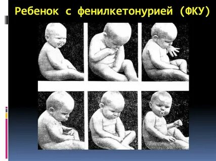 Синдром фенилкетонурия