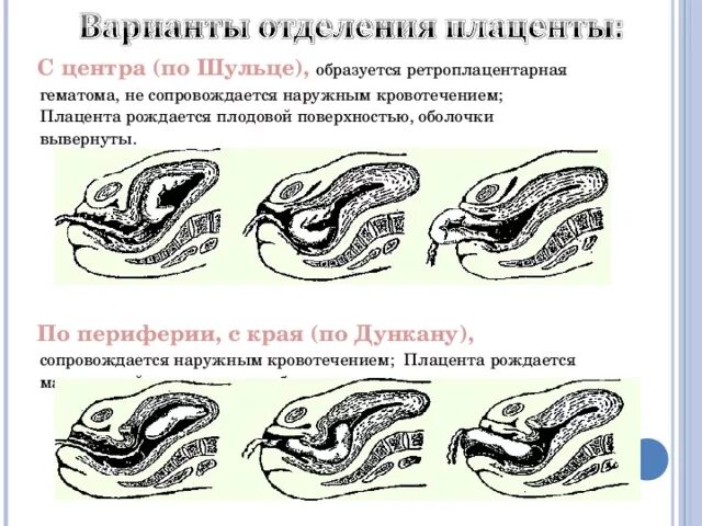 Определите Тип отслойки плаценты. Центральный механизм отделения плаценты. Варианты отделения плаценты в третьем периоде родов. Механизм отделения плаценты по Шульце.