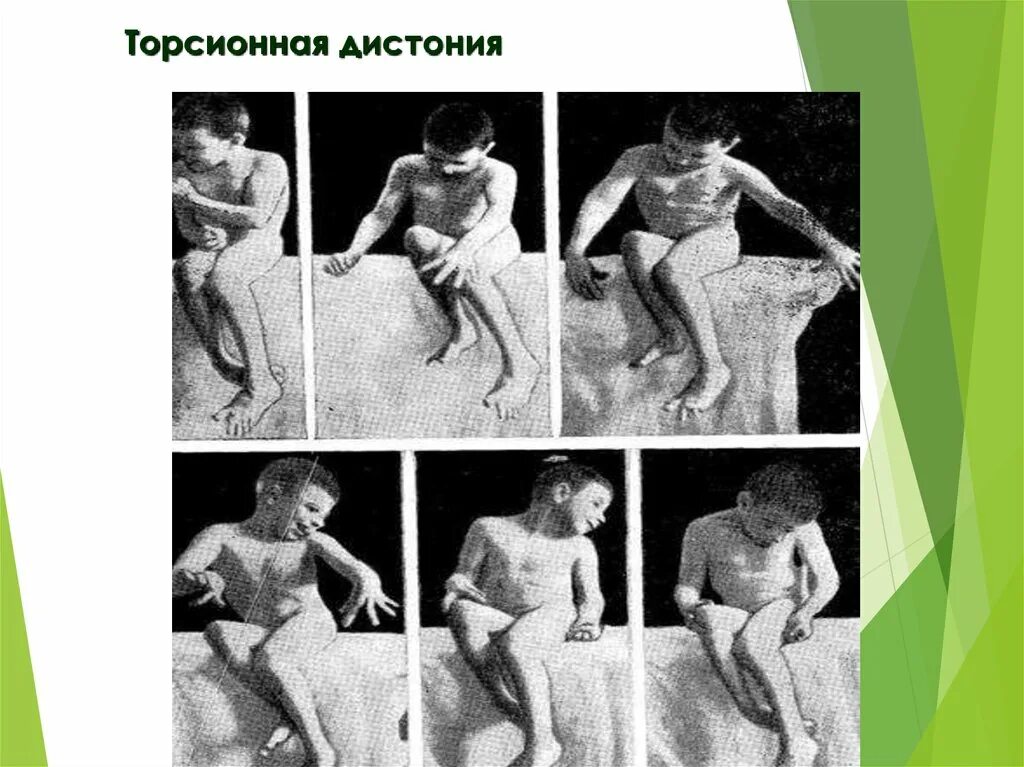 Дцп мышцы. Гиперкинезы торсионная дистония. Торсионная дистония генерализованная форма. Торсионная мышечная дистония. Торсионная дистония у детей.