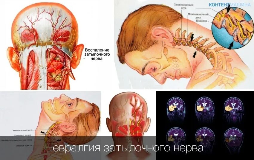 Может ли в затылке. Воспаление затылочных нервов. Воспаление затылочного нерва. Невралгия затылочного нерва нерва.