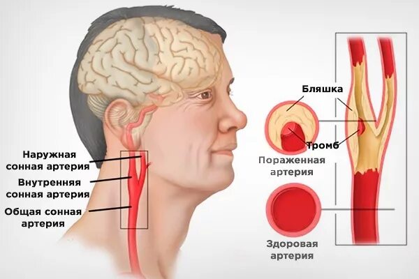 Где находится сонная артерия у мужчин. Атеросклероз сонных артерий. Сонная артерия расположение.