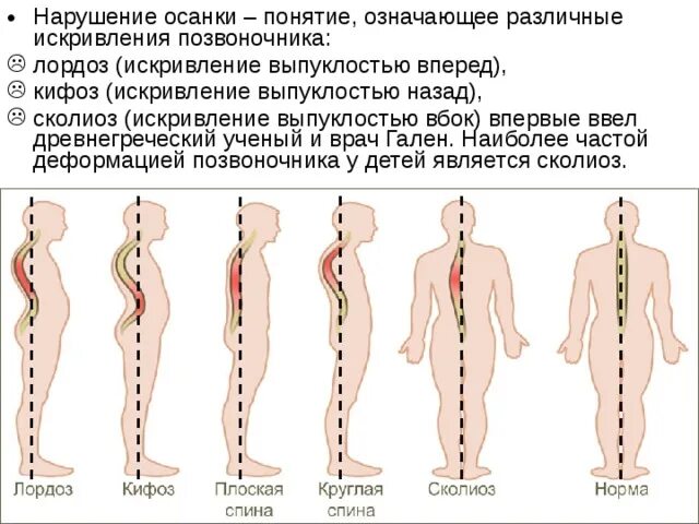 Нарушение изгиба позвоночника. Осанка лордоз кифоз сколиоз. Сколиоз кифоз лордоз остеохондроз. Искривление осанки лордотическая. Нарушение осанки лордоз кифоз сколиоз.