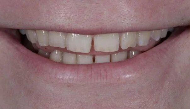 Бруксизм зубы стертость. Восстановление зубов бруксизм. Сильно сжатые зубы
