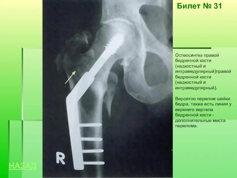 Внутрикостный остеосинтез шейки бедра. Перелом шейки остеосинтез. Перелом шейки бедра остеосинтез. Перелом шейки бедра остеосинтез рентген.