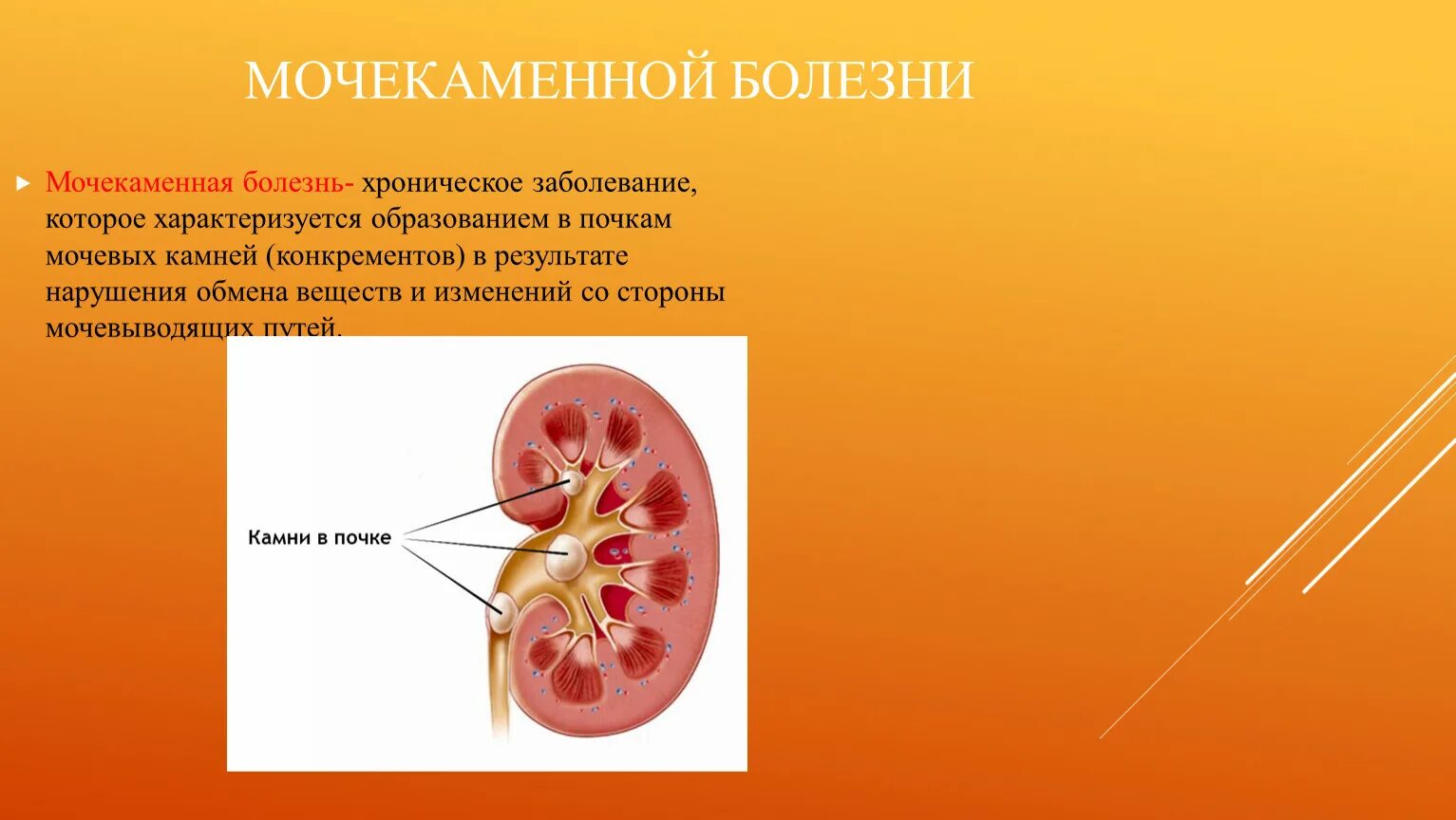 Мочекаменная болезнь патанатомия. Хронический пиелонефрит при мочекаменной болезни. Патология почек - мочекаменная болезнь. Мочекаменная болезнь биология 8 класс. Поражение почек характерно для