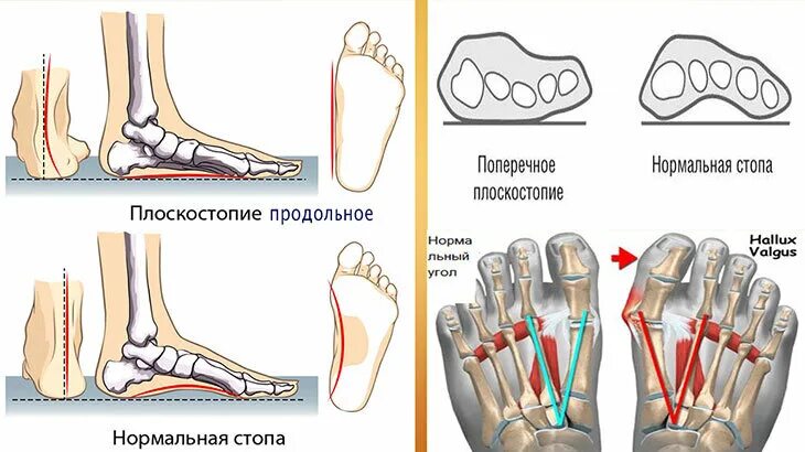 Средняя стопа. Продольно-поперечное плоскостопие. Продольное поперечное и комбинированное плоскостопие. Поперечно-продольное плоскостопие. Плоскостопие поперечного свода стопы.