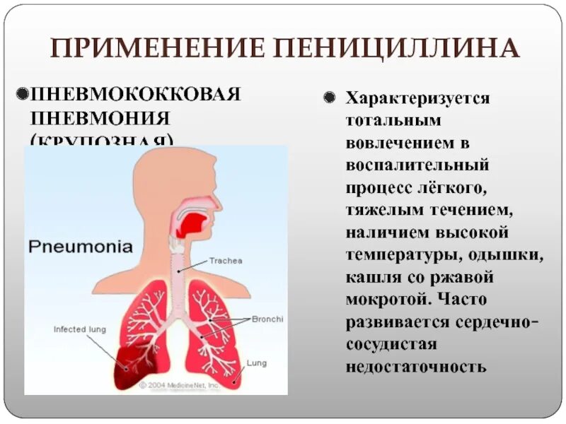 Кашель воспаление легких.. Кашель пневмонии у взрослых. Проявления пневмонии у человека. Насморк с мокротой без кашля