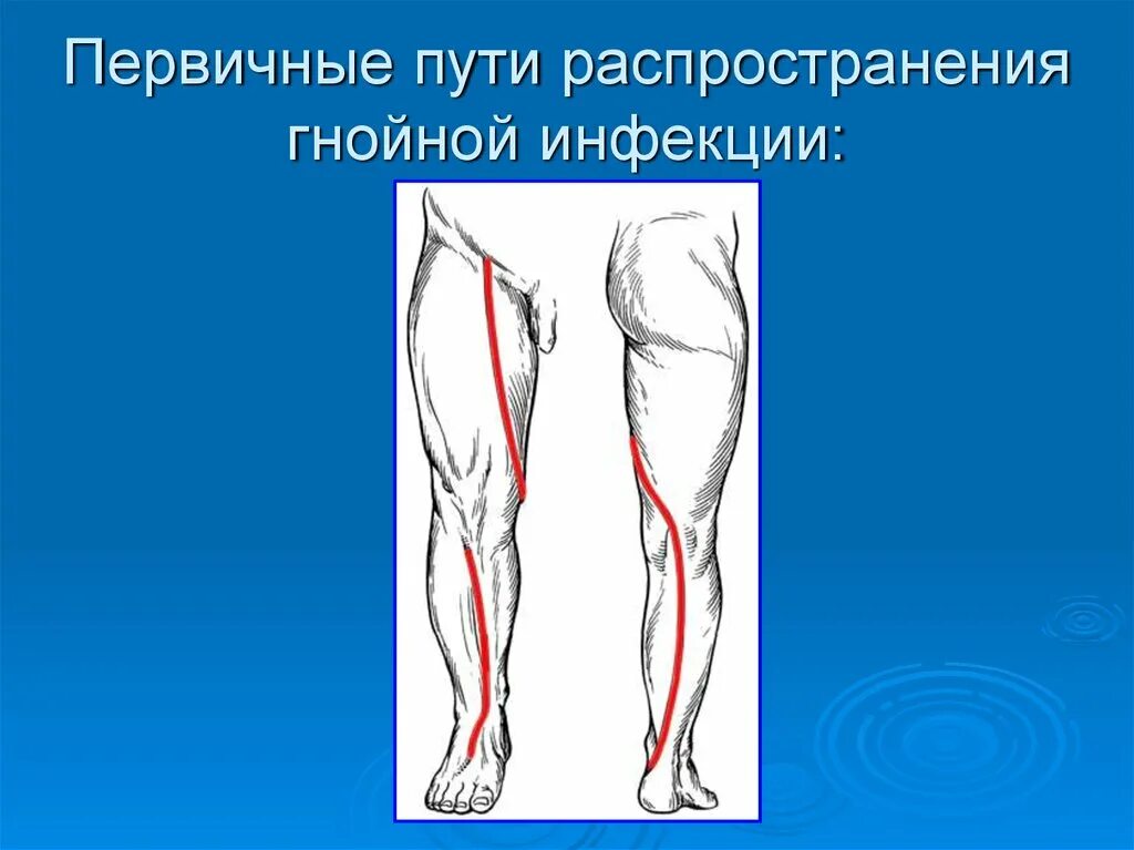 Флегмоны бедра пути распространения. Флегмоны бедра пути распространения. Флегмоны бедра пути распространения. Основная причина развития лимфангита. Флегмоны бедра пути распространения.