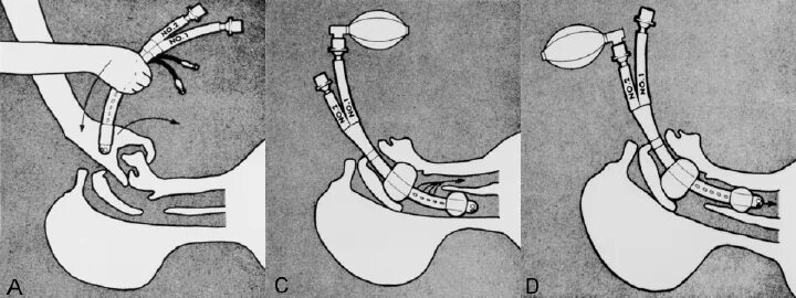 Трубка при наркозе. Анестезия: эндотрахеальный наркоз.. Эндотрахеальная трубка для наркоза. Интубационная анестезия. Пищеводно-трахеальная комбинированная трубка.