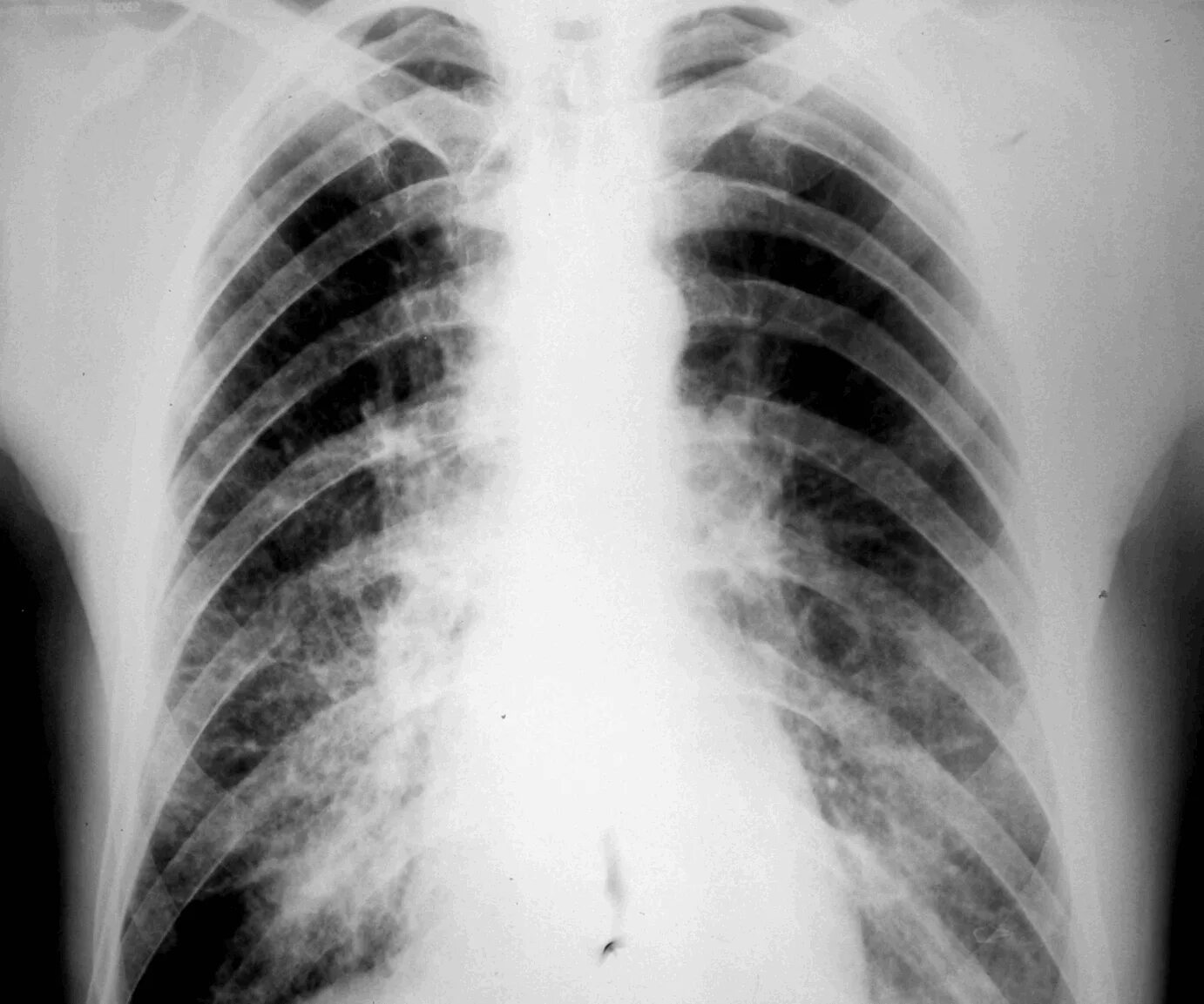 Поражен легких 3. Диссеминированное поражение легких рентген. Очаговая диссеминация легких.