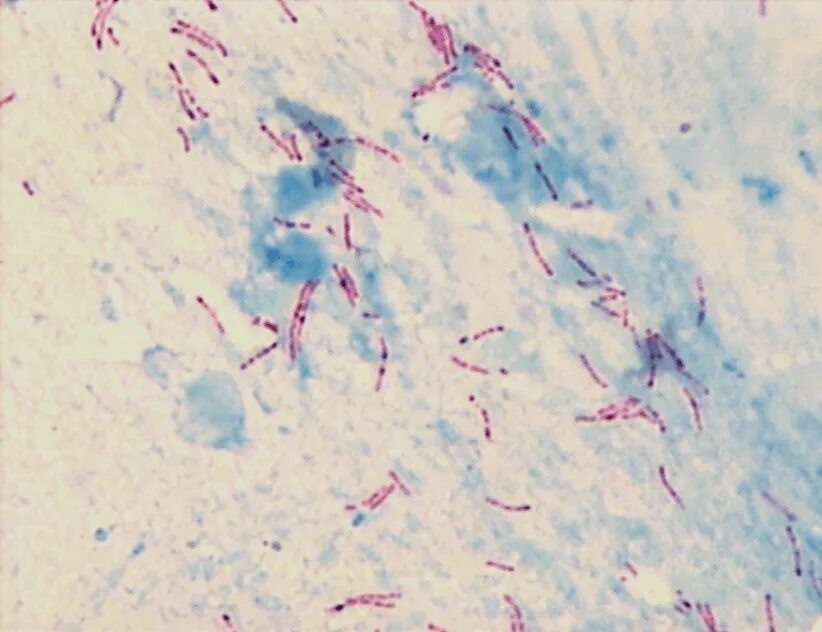 Микобактерии туберкулеза микроскопия по Цилю Нильсену. Палочка Коха по Цилю-Нильсену. Микобактерия туберкулеза по Цилю Нильсену в мокроте. Окраска микобактерий по Цилю-Нильсену микобактерии.